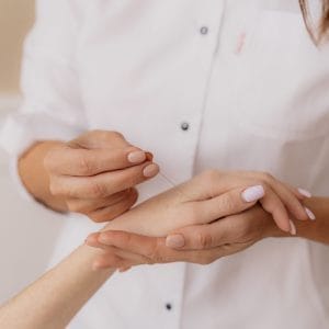 Acupuncture needles being placed in woman's hand