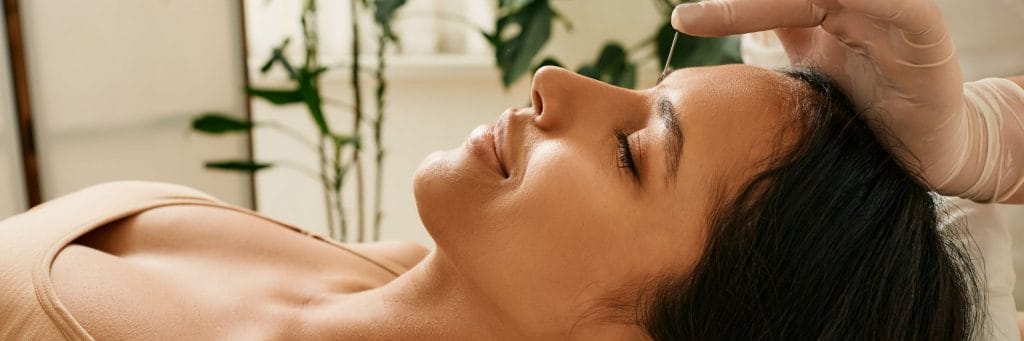 Woman lying down getting acupuncture needles placed in her forehead